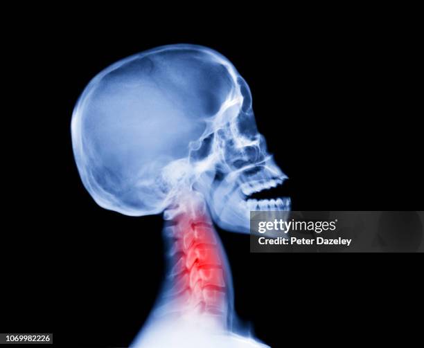 xray of human skull with whiplash - neck pain stock pictures, royalty-free photos & images