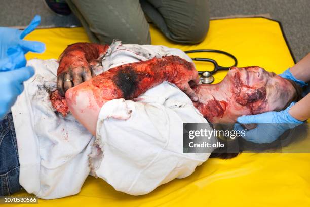 first aid paramedic training - emergency treatment - burns victims stock pictures, royalty-free photos & images