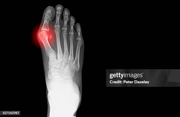 x-ray showing bunion on human foot - hallux valgus stock pictures, royalty-free photos & images