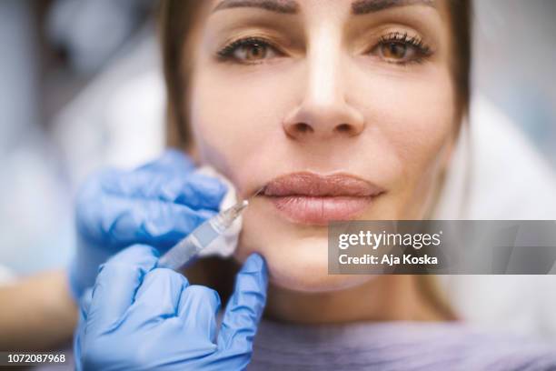 lips augmentation. - ácido hialurónico imagens e fotografias de stock