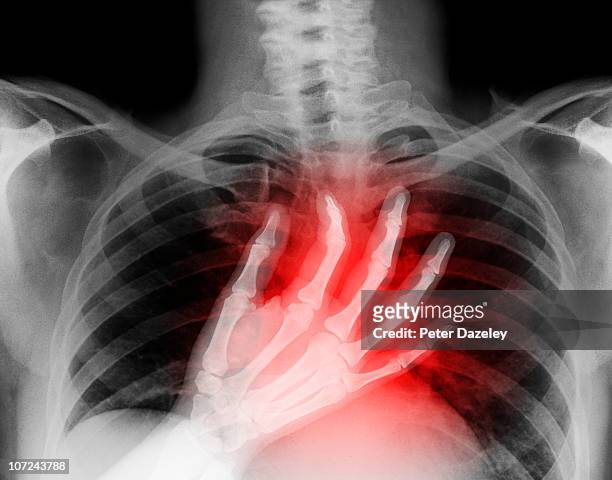 x-ray of hand on heart - heart disease fotografías e imágenes de stock