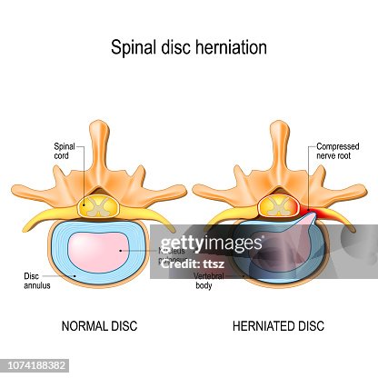 Normal Spinal Disc Normal Disc And Spinal Disc Herniation In Cervical Vertebrae High-Res ...