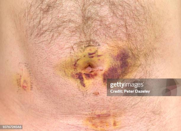 laparoscopy post hernia operation scars - machucado imagens e fotografias de stock