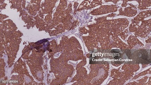 pancreatic cancer, peritoneal metastases of pancreatic adenocarcinoma, immunohistochemical staining, histopathology - macrofago foto e immagini stock