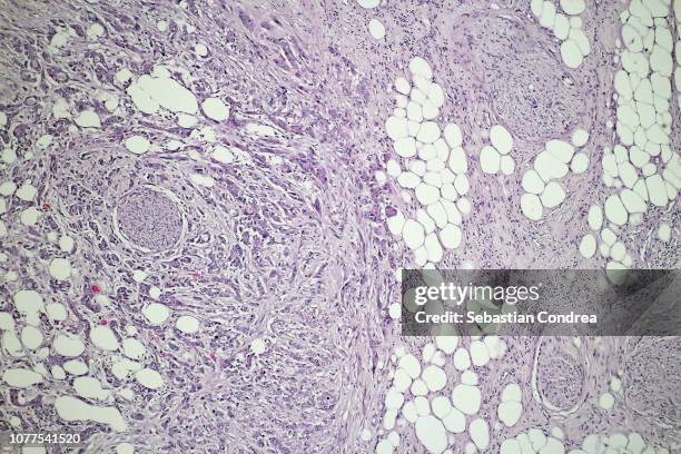 abdominal fat of pancreatic cancer, micrograph of squamous cell carcinoma of the peritoneal metastases of pancreatic adenocarcinoma, histopathology - tejido epitelial fotografías e imágenes de stock