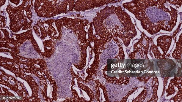 peritoneal metastases of pancreatic adenocarcinoma, immunohistochemical staining, histopathology,hamamatsu - animal medical center stock pictures, royalty-free photos & images