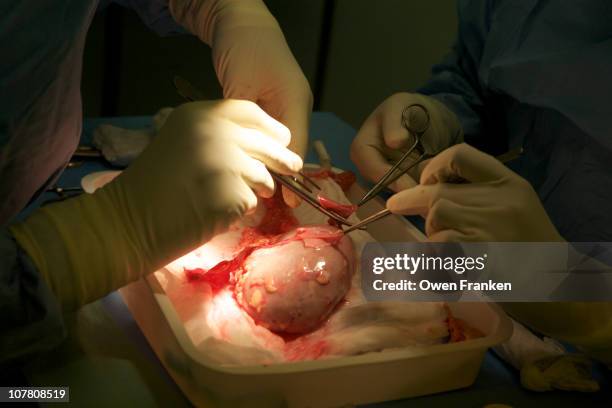 kidney transplant operation - órgão interno imagens e fotografias de stock