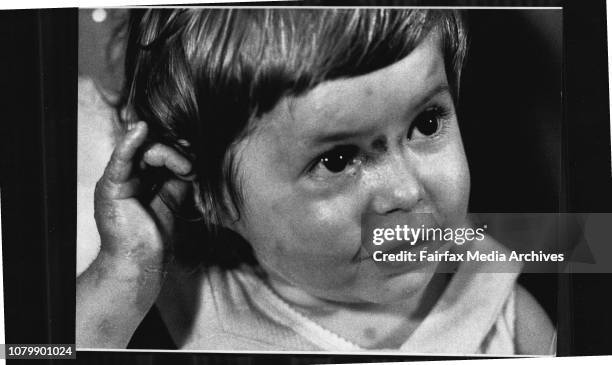 At Prince of Wales Children's hospital.Cotton wool babies. Pic is of Rebecca Brewer aged 16 months who is suffering from the skin disease. Pic taken...