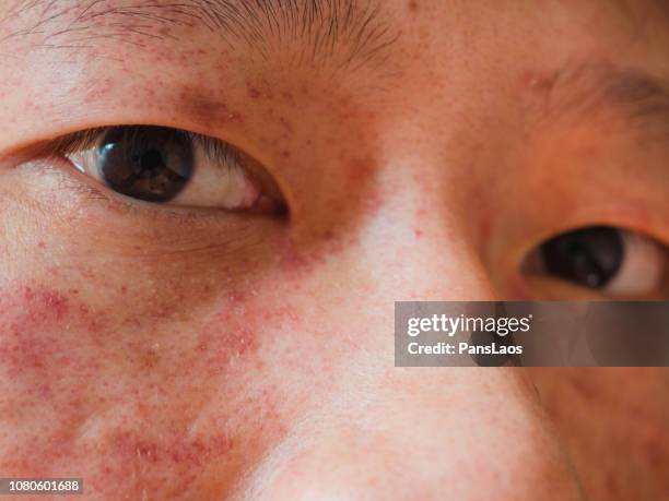 medical allergic dermatitis skin on eye - psoriasis stock pictures, royalty-free photos & images