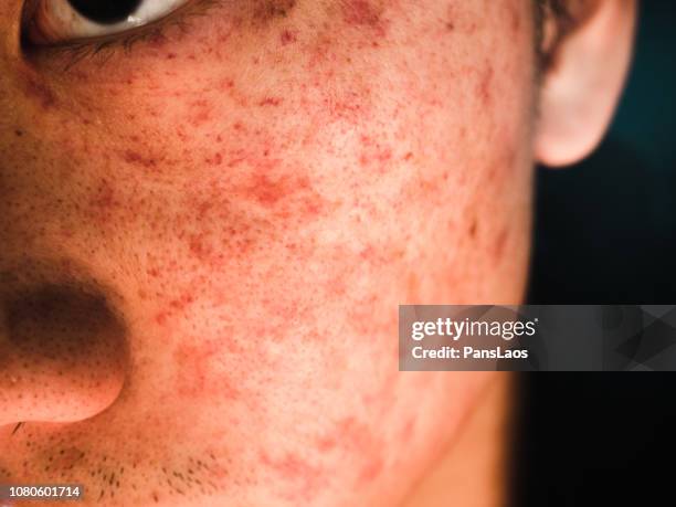 allergic dermatitis skin on face - huidaandoening stockfoto's en -beelden