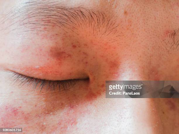 medical allergic dermatitis skin on face - dermatitis stock pictures, royalty-free photos & images