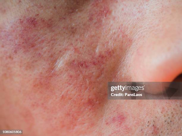 allergic dermatitis skin on face - psoriasis fotografías e imágenes de stock