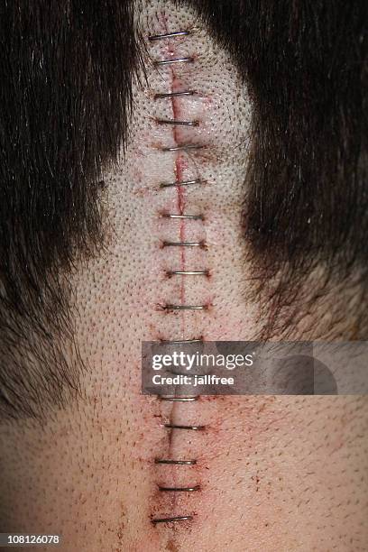 staples on scar on back of head after operation - head wound stock pictures, royalty-free photos & images