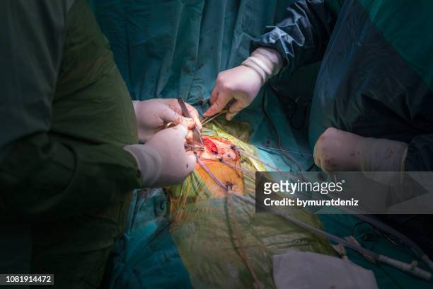 heart surgery in hospital - heart surgery stock pictures, royalty-free photos & images