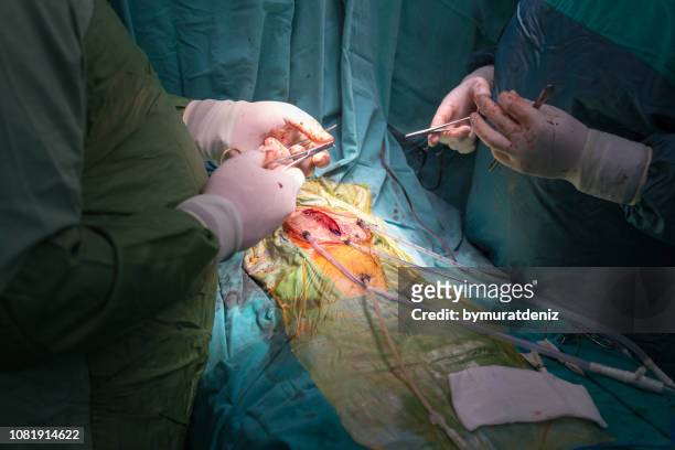 cirugía cardíaca en el hospital - aorta fotografías e imágenes de stock