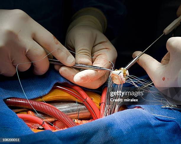 heart surgery aortic valve replacement - aorta stock pictures, royalty-free photos & images