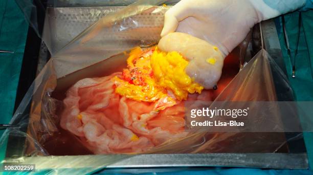 kidney transplant in operating room - intern menselijk orgaan stockfoto's en -beelden