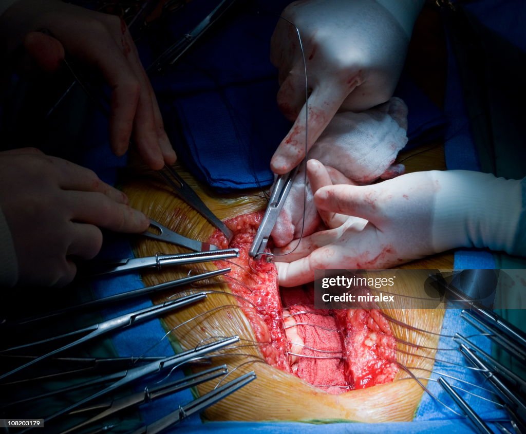 Heart Surgery - Sternal Closure