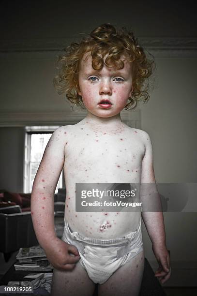 retrato de niño con la varicela - varicela fotografías e imágenes de stock