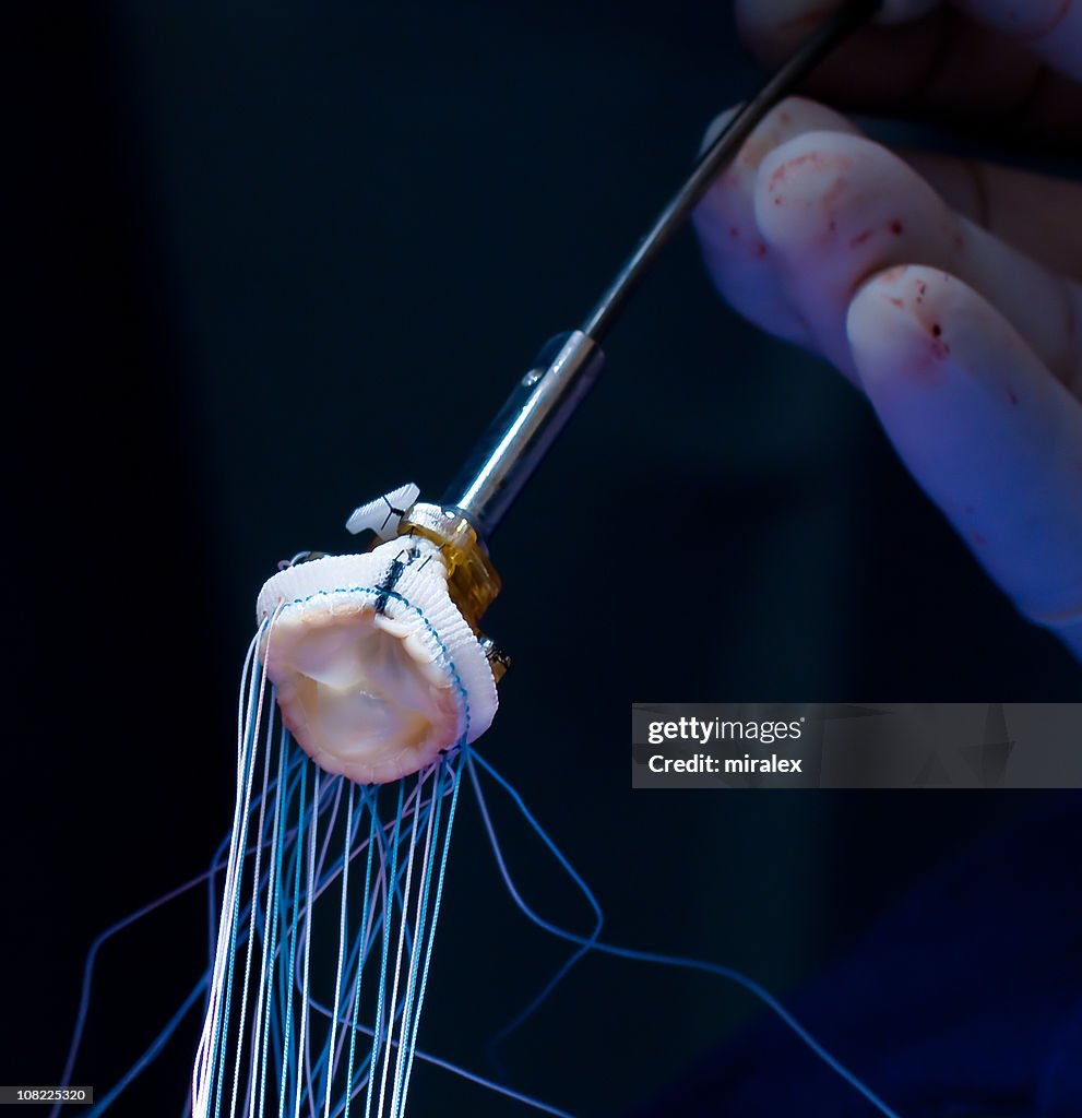 Heart Surgery Aortic Valve Replacement