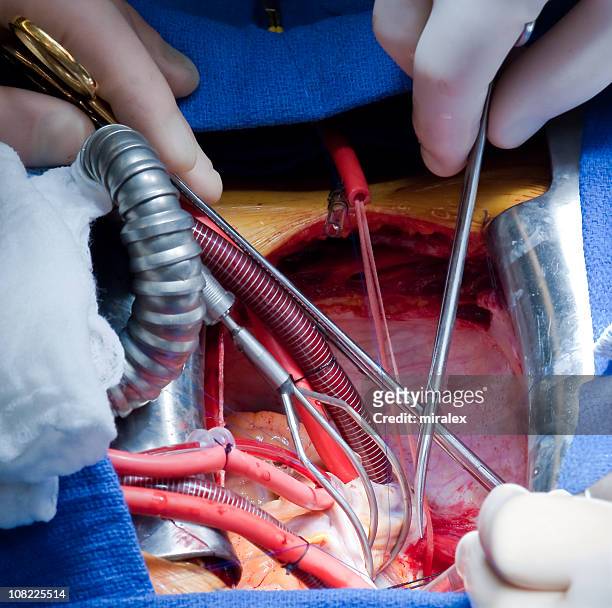 mitral valve repair heart surgery - open heart surgery stock pictures, royalty-free photos & images