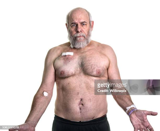 anxious senior man chemotherapy chest port cancer patient showing scars - male chest stock pictures, royalty-free photos & images