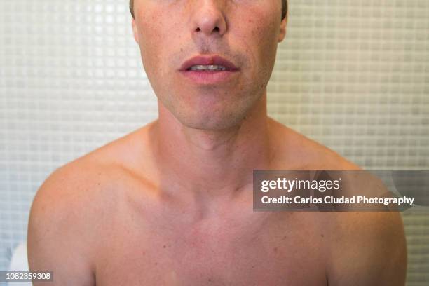 portrait of man face with herpes simplex virus on his lips - genital herpes stock pictures, royalty-free photos & images