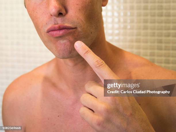 young man pointing at his mouth with cold sore on upper lip - cold sore stock-fotos und bilder