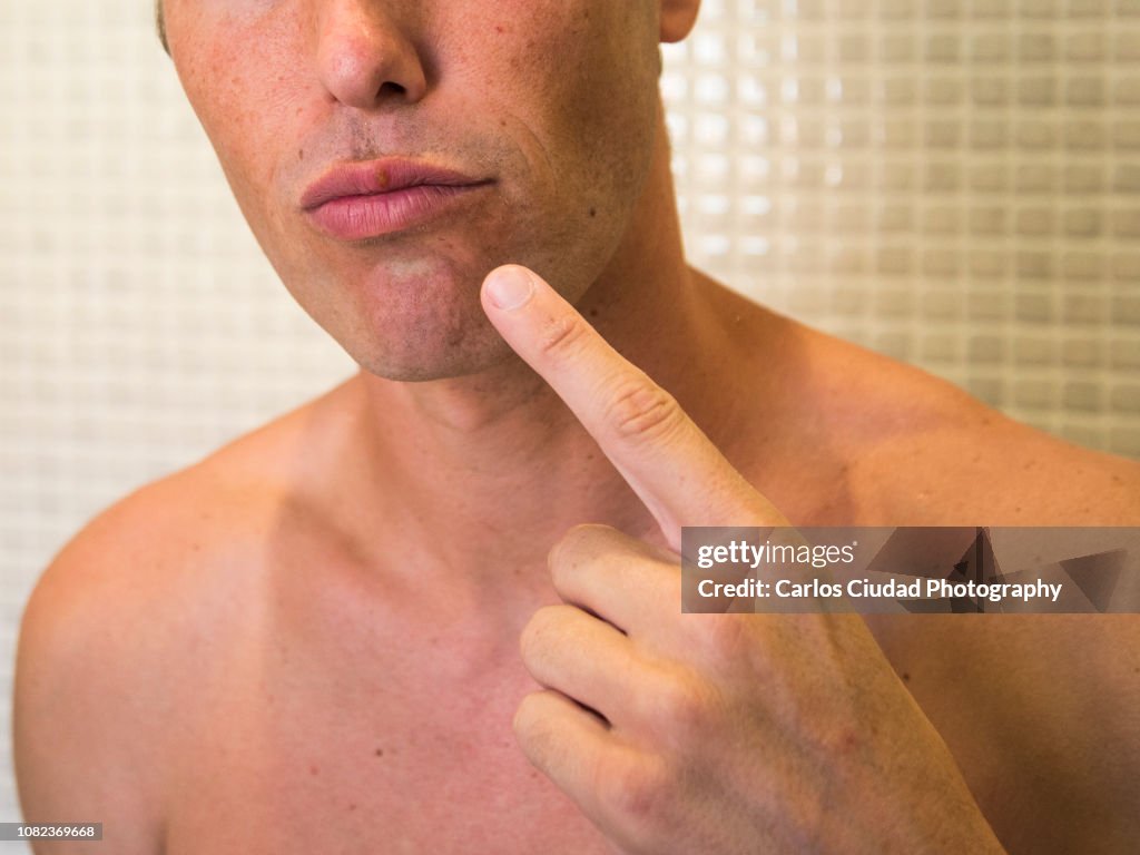 Young man pointing at his mouth with cold sore on upper lip