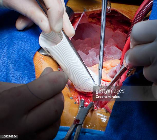 repair of ascending aorta with synthetic material - aortas stock pictures, royalty-free photos & images