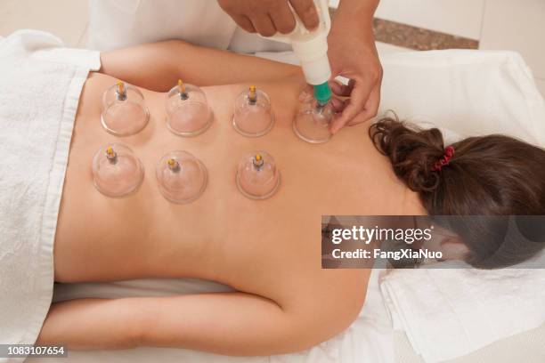 chinese doctor cupping patient's back - massage therapy stock pictures, royalty-free photos & images