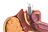 Endotracheal Intubation. Human head cross section