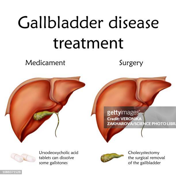 ilustraciones, imágenes clip art, dibujos animados e iconos de stock de gallbladder disease treatment, illustration - vesícula biliar
