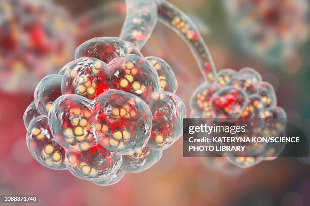 pneumococcal pneumonia, illustration - streptococcus pneumoniae stock illustrations