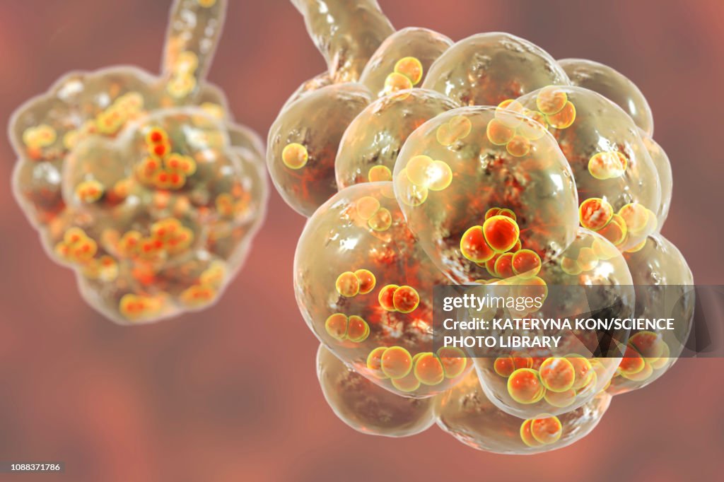 Pneumococcal pneumonia, illustration