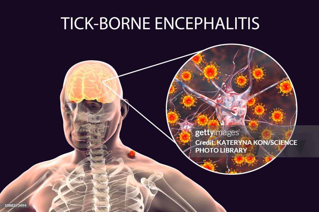 Tick-bourne encephalitis, illustration