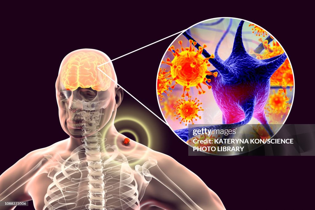Tick-bourne encephalitis, illustration