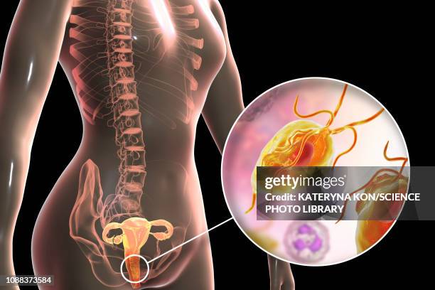trichomoniasis, illustration - trichomoniasis stock illustrations