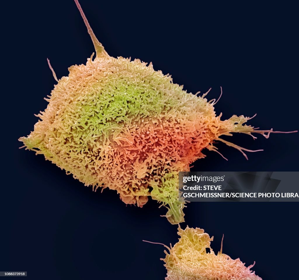 Cervical cancer cell, SEM