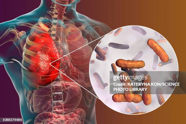 pneumonia caused by moraxella catarrhalis, illustration - hospital acquired infection stock illustrations