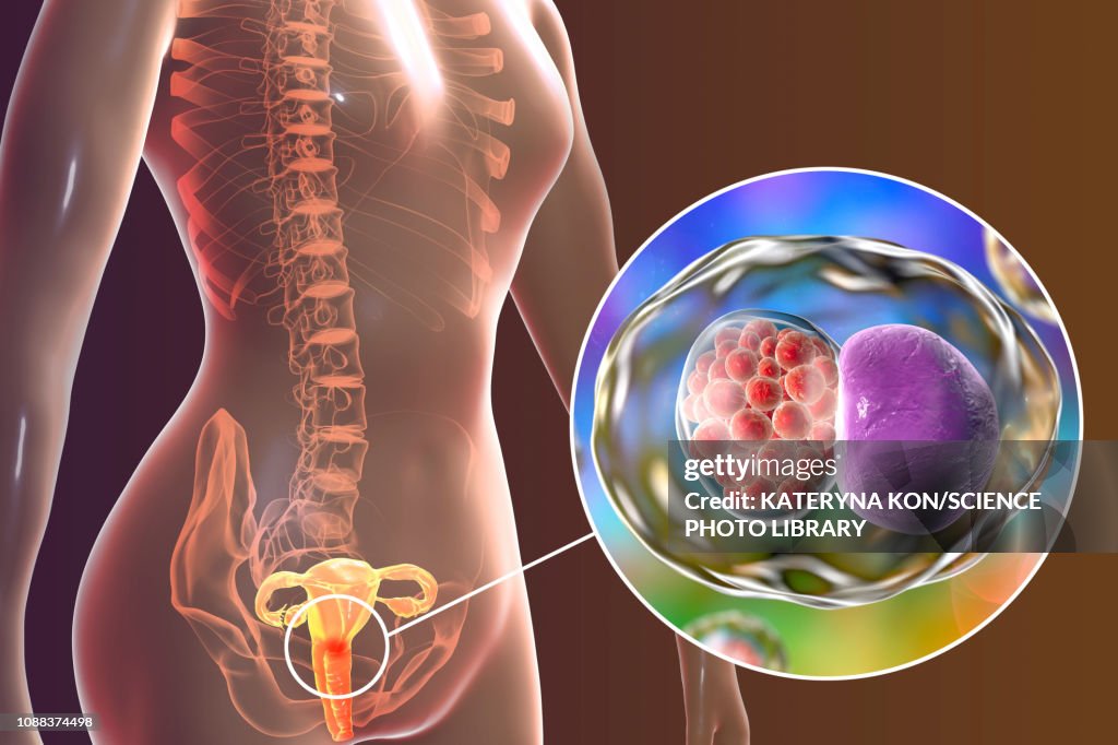 Chlamydia infection, illustration