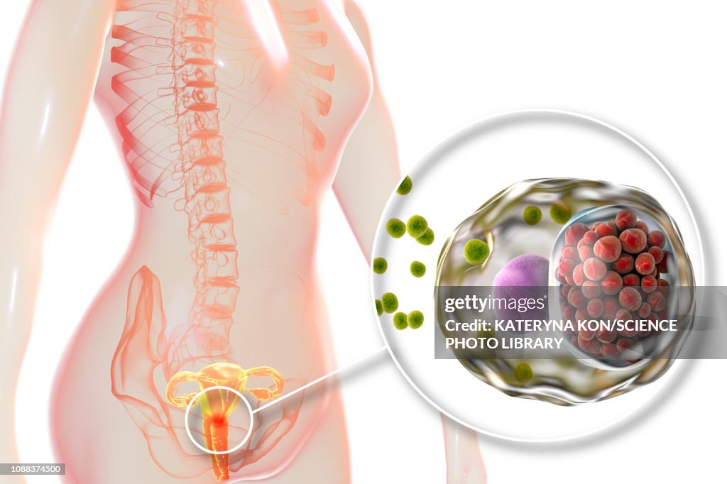 Chlamydia infection, illustration