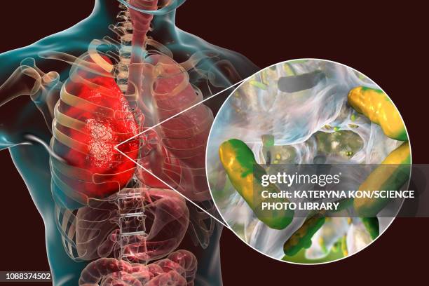 pneumonia caused by moraxella catarrhalis, illustration - hospital acquired infection stock illustrations