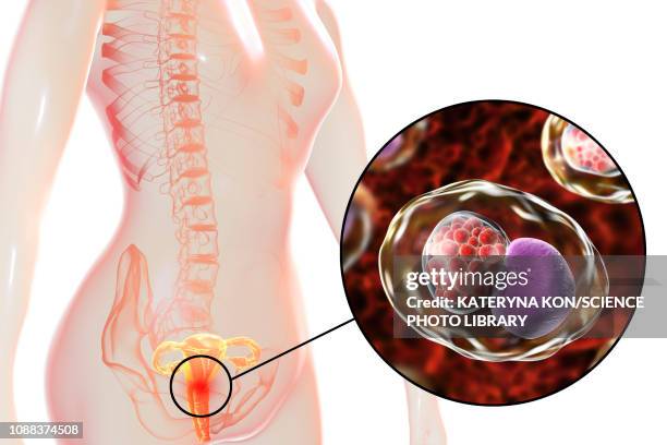 chlamydia infection, illustration - unknown location stock illustrations