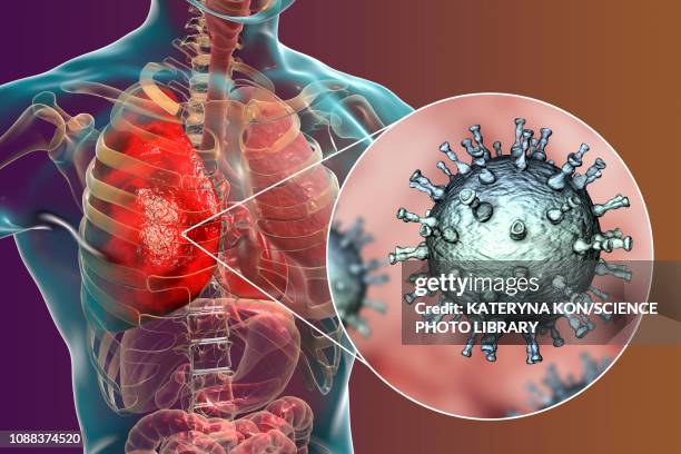 pneumonia caused by varicella zoster virus, illustration - varicella zoster virus stock illustrations