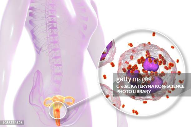 stockillustraties, clipart, cartoons en iconen met gonorrhoea infection in female, illustration - neisseria gonorrhoeae