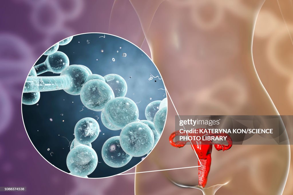 Candida Candida Albicans Infection In Female Illustration High-Res Vector ...