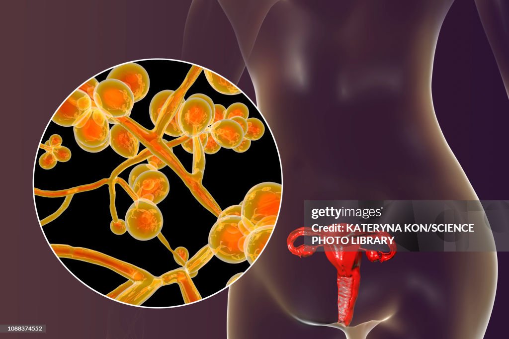 Candida Candida Albicans Infection In Female Illustration High-Res Vector ...
