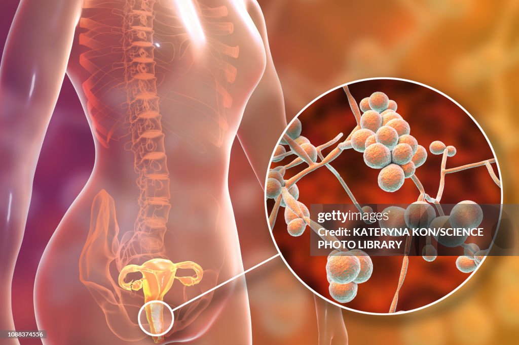 Candida albicans infection in female, illustration