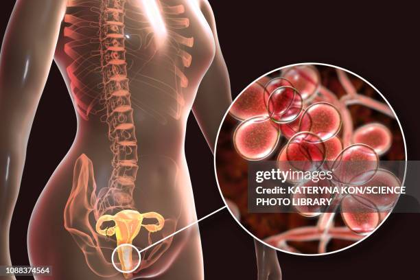 illustrations, cliparts, dessins animés et icônes de candida albicans infection in female, illustration - commensalisme